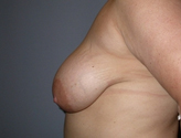 Patient # 82406 Before Photo # 5